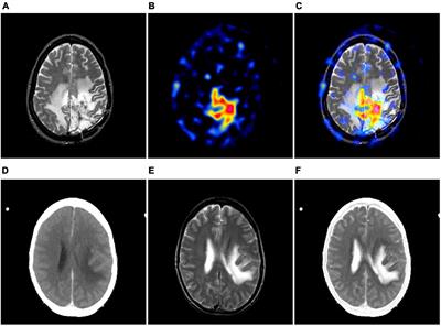 G2NPAN: GAN-guided nuance perceptual attention network for multimodal medical fusion image quality assessment